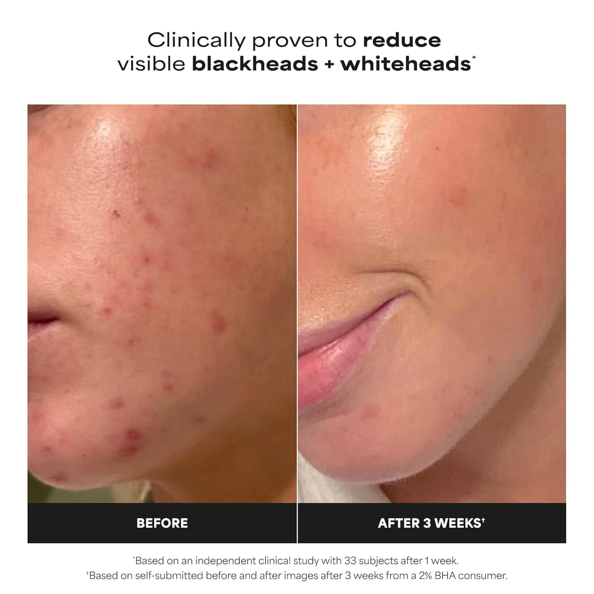Revitalize Your Skin with Paula's Choice SKIN PERFECTING 2% BHA Liquid Leave-On Exfoliant - For Unclogged Pores and Youthful Glow