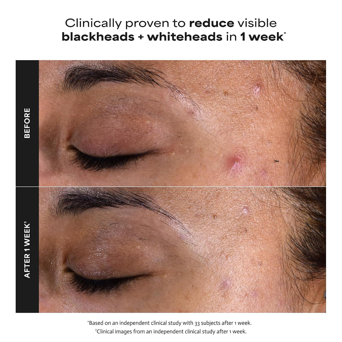 Revitalize Your Skin with Paula's Choice SKIN PERFECTING 2% BHA Liquid Leave-On Exfoliant - For Unclogged Pores and Youthful Glow